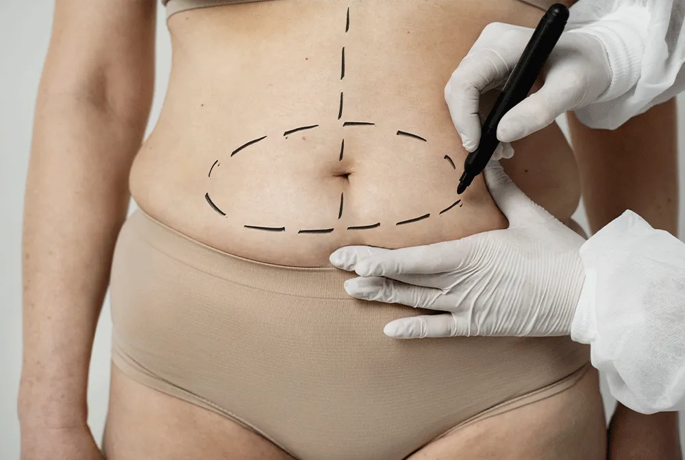 Abdominoplastika nədir?